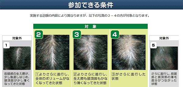 AGA治験バイト参加条件